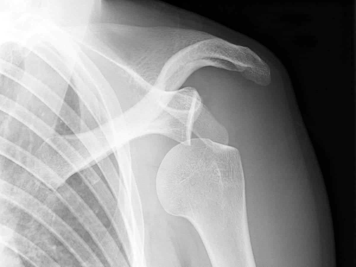 shoulder dislocation