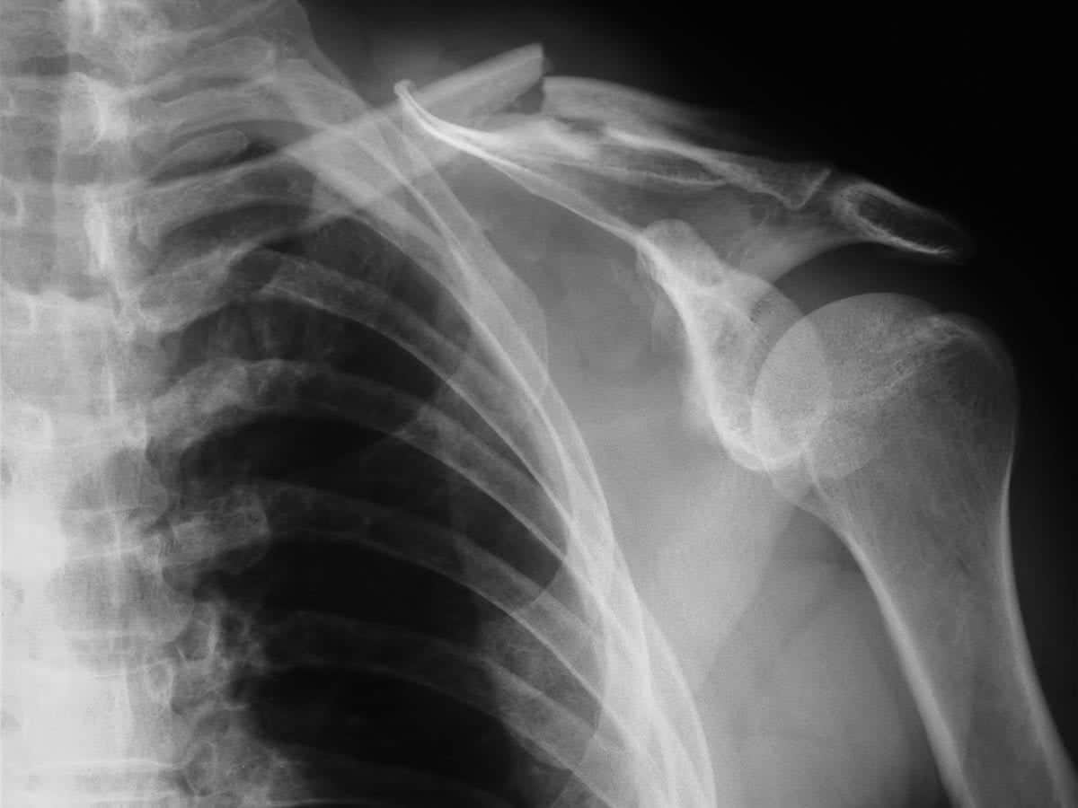 Dr Terence Moopanar | Shoulder fracture management